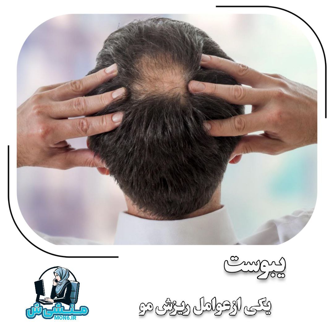 یبوست یکی از عوامل ریزش مو
